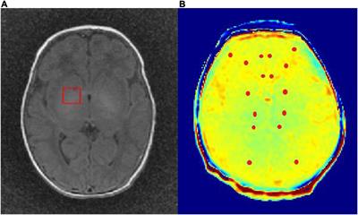 Imaging of nerve injury in neonatal acute bilirubin encephalopathy using 1H-MRS and Glu-CEST techniques